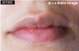 リップホワイトニングセッション前2